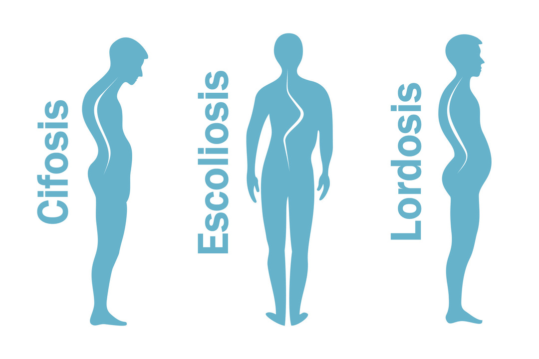 What is Lordosis, Scoliosis and Kyphosis