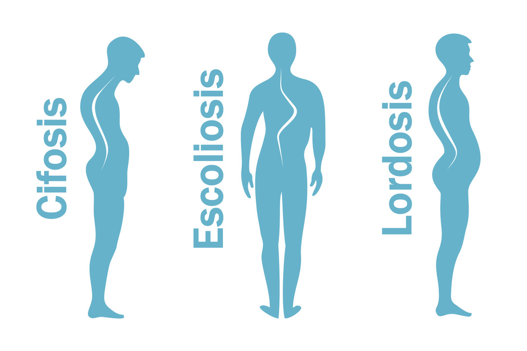 脊柱前弯症、脊柱側弯症、後弯症とは