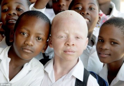 Albinismi