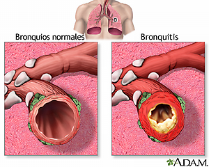 Bronquite