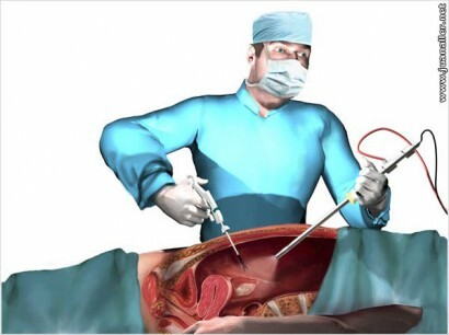 Poliklinische laparoscopie